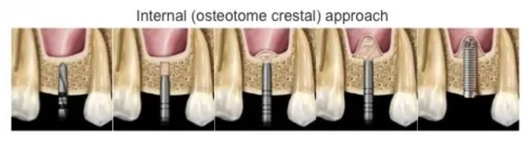 Closed Sinus Lift